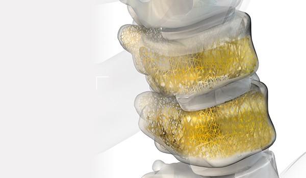 OSTEOPAL - bone cements for spinal surgery